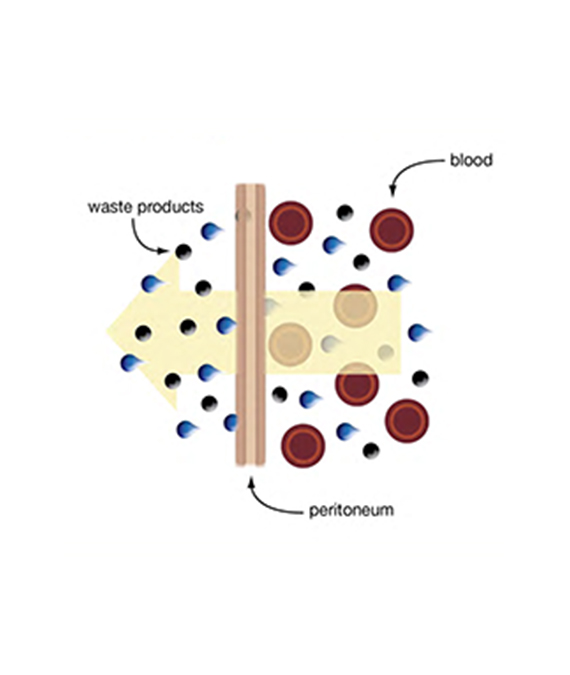 peritoneal waste