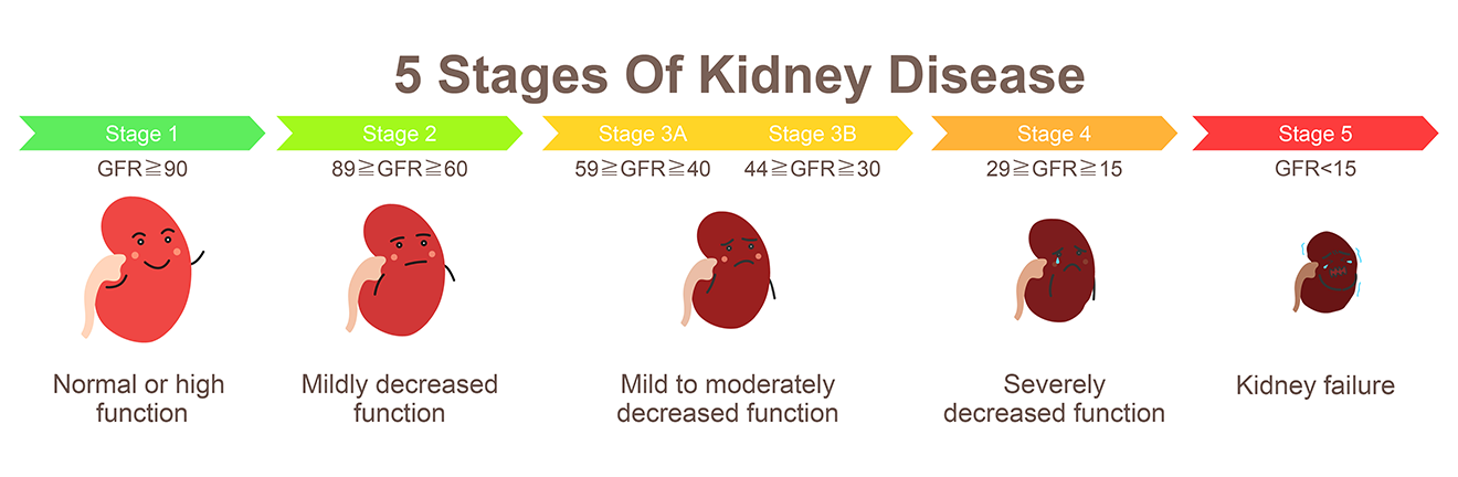 Five kidneys in various stages of chronic kidney disease. As kidney disease progresses from Stage 1 to Stage 5, the kidneys lose function and get smaller.