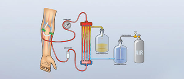 dialysis